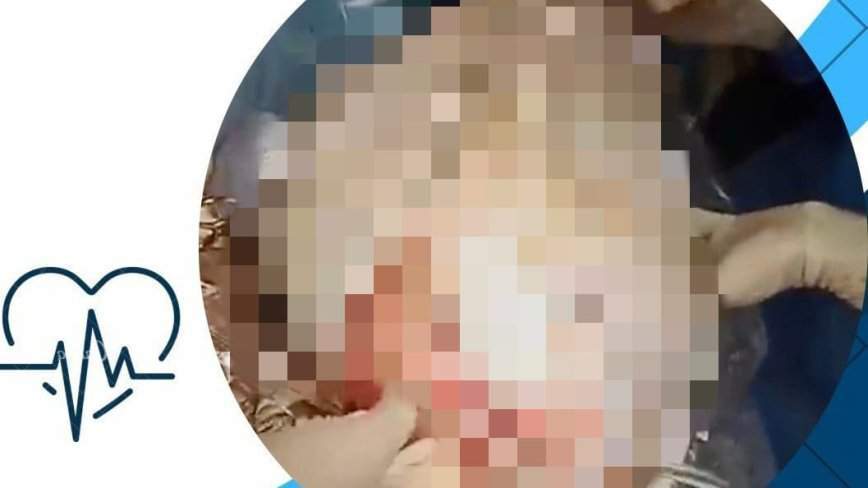Это не фотошоп: настоящего «гиганта» извлекли из пациентки врачи Владивостока