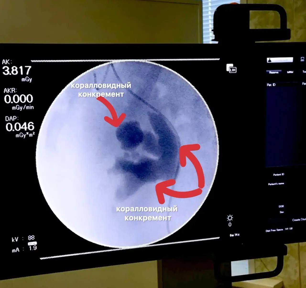 Во Владивостоке опасный гигант жил в теле женщины с её молчаливого согласия